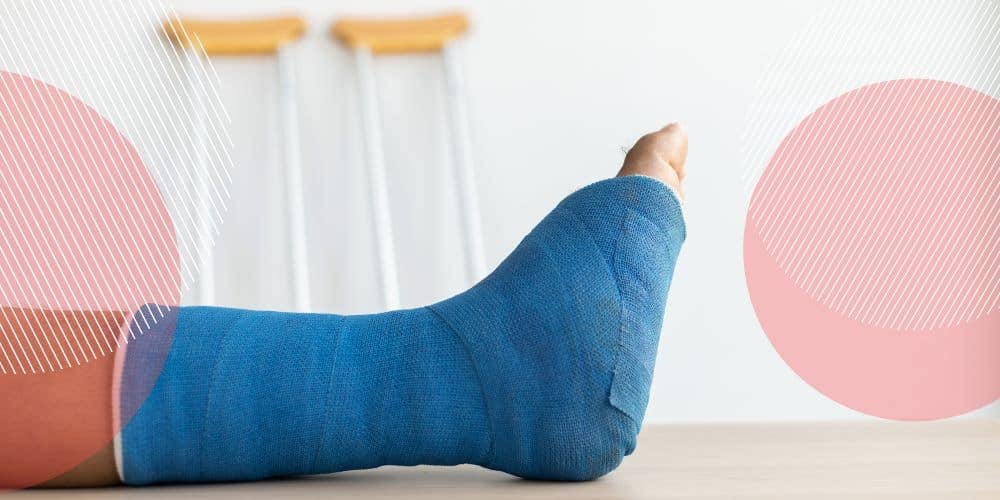 Imagem de uma perna engessada com gesso azul retratando o afastamento do trabalho por acidente